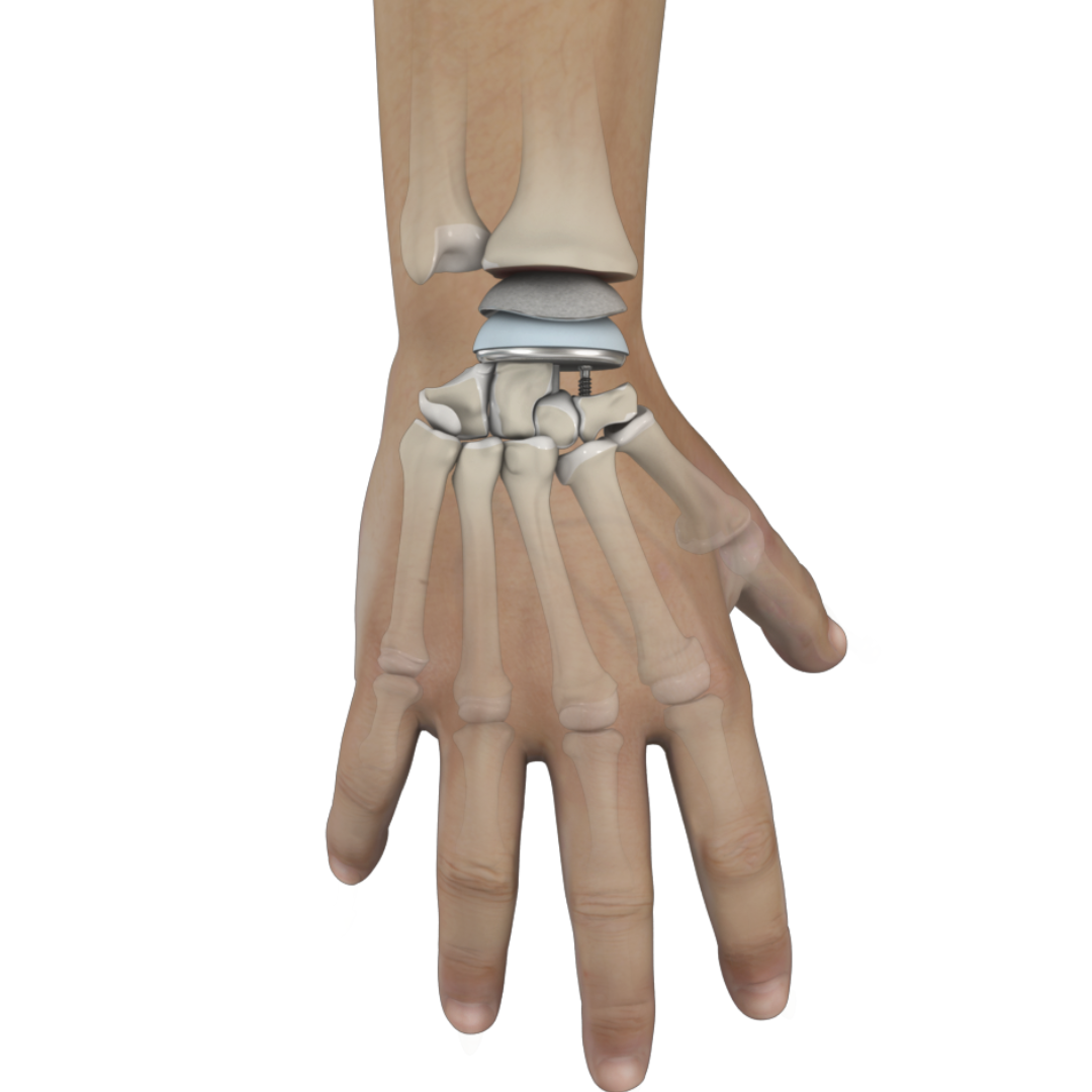 Total Wrist Replacement Surgery icon